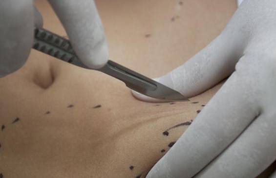 Extranjera murió en Cali luego de realizarse una cirugía estética